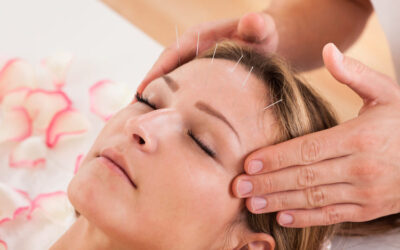 Does Acupuncture Help With Migraines and Headaches?