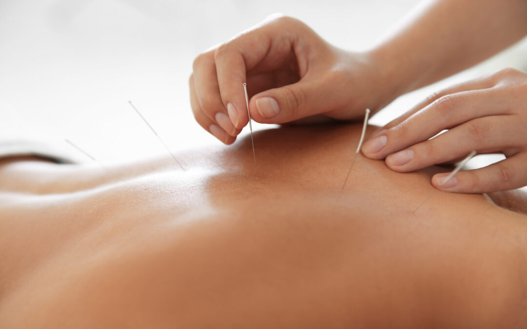 Can Acupuncture and Chiropractic Care Be Combined?
